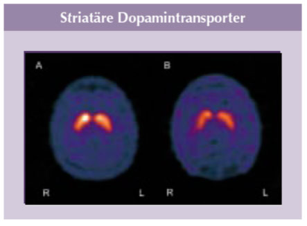Dopamintransporter von ADHS-Patient