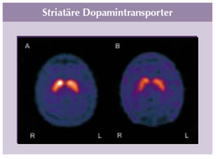 Dopamintransporter von ADHS-Patient Dopamintransporter von ADHS-Patient